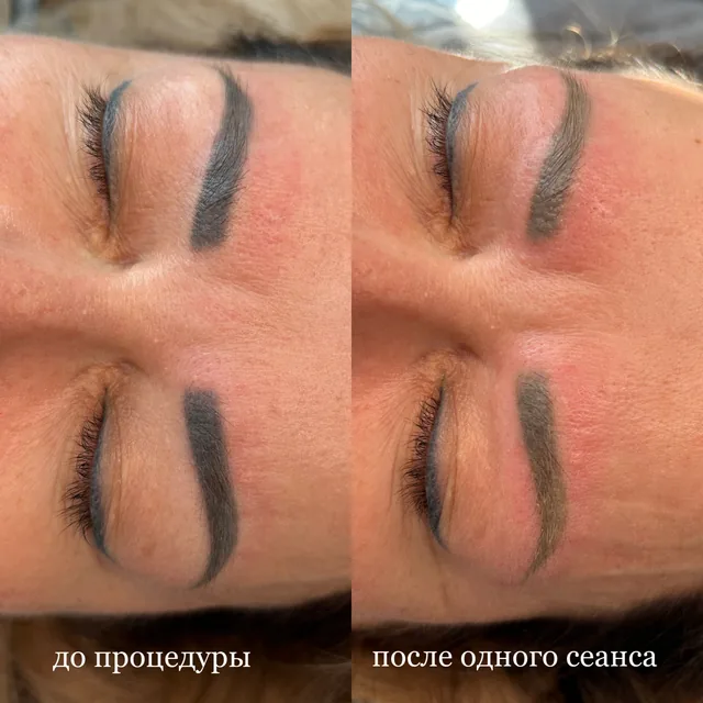 Удаление