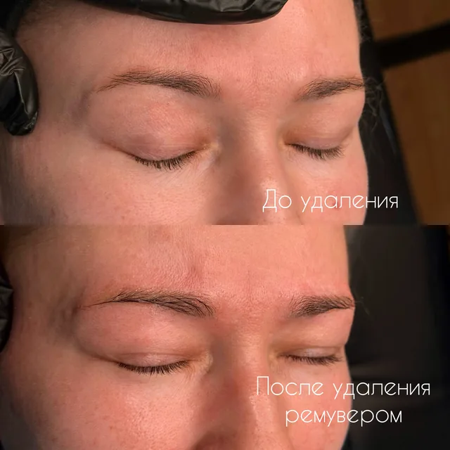 Удаление